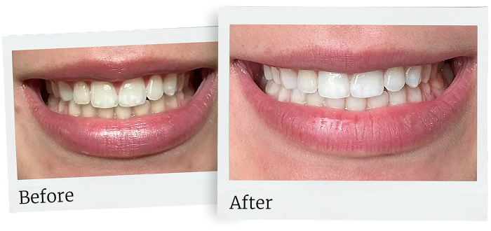 best teeth whitening for tobacco stains Smokers: How to Remove allowing the whitening formula to help gently remove stains and brighten your teeth Venus Visage Teeth Whitening Pen